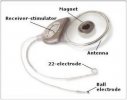 cochlear_implant_1.jpg